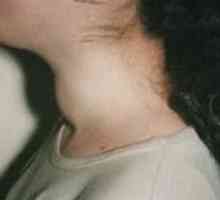 Gusa nodulara (noduli tiroidieni)