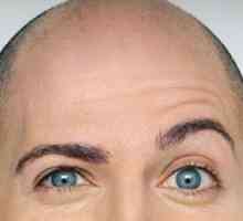 Tipuri de chelie (alopecie)