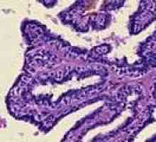 Papilom intraductal