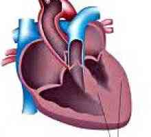 Cardiomiopatie secundară