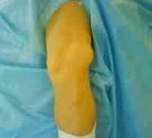 Dislocarea articulației genunchiului