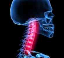 Dislocarea vertebrelor cervicale. Simptomele și tratamentul luxației