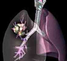 Tumori pulmonare maligne