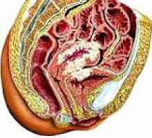 Tumorile maligne ale uterului