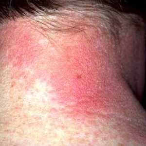 Dermatitei alergice: simptome și tratament