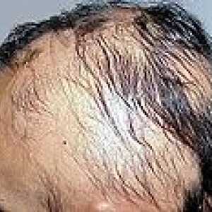 Alopecie