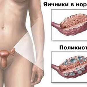 Sindromul ovarului polichistic PCOS