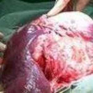 Angiosarcomul ficatului