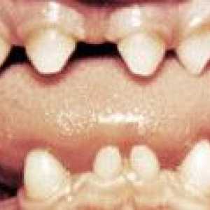 Anomalii de forma dinților