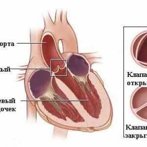 Insuficienta aortica (valva aortica)