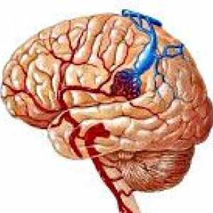 Malformații arterio-venoase ale creierului