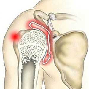 Artrita articulației umărului