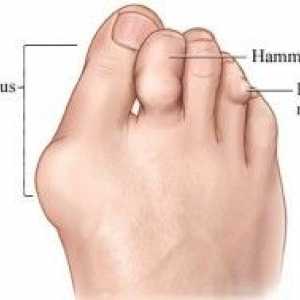 Artrita a articulațiilor degetelor de la picioare
