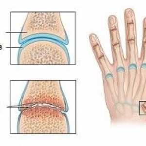 Articulațiilor artritice ale degetelor