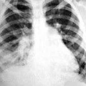 Pneumonie inhalare