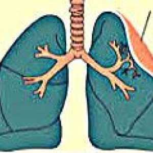 Atelectazie pulmonară