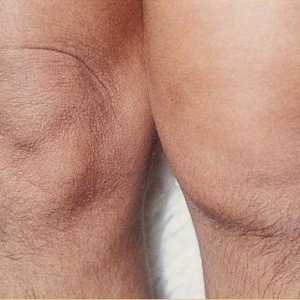Durere în genunchi (articulația genunchiului)