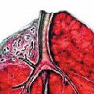 Tuberculoză pulmonară cirozelor