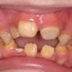 Defecte dentare