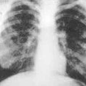 Fibroză pulmonară difuză