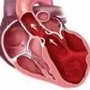 Cardiomiopatie dilatativă