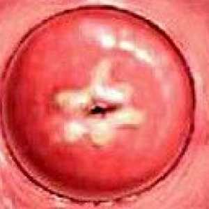Displazie de col uterin