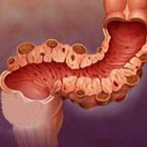 Diverticulii de colon sigmoid