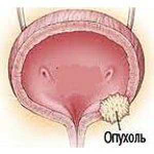 Tumorile benigne ale vezicii urinare