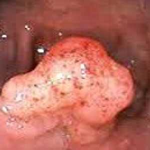 Tumorile benigne ale intestinului gros