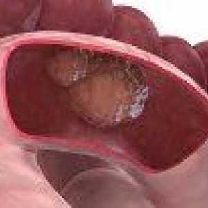 Tumorile benigne ale intestinului subțire