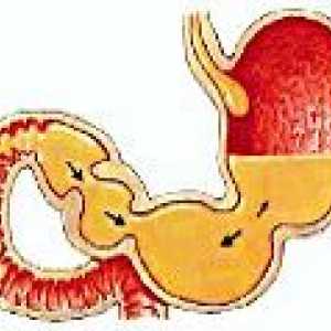 Reflux duodeno gastric