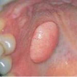 Fibromul orală