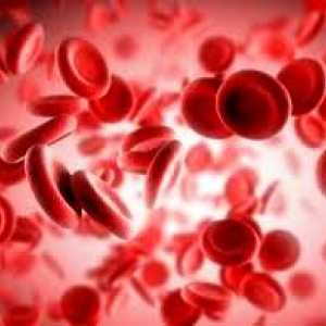 Anemie hemolitică