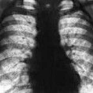 Hemosideroza pulmonară
