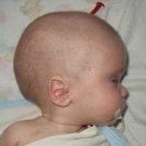 Hidrocefalia la copii