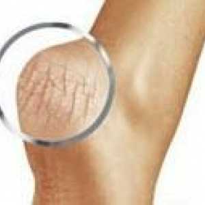 Picioare hipercheratozice
