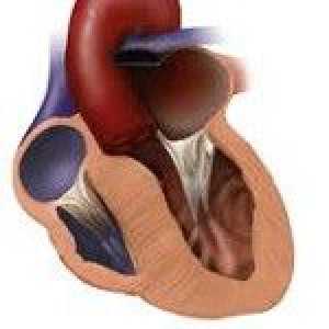 Cardiomiopatie hipertrofică