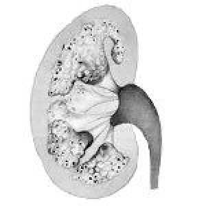 Burete de rinichi