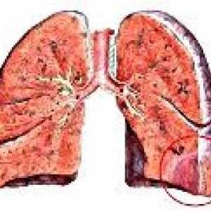 Infarct pulmonar