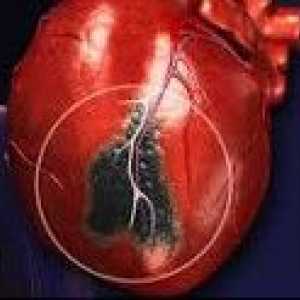 Infarct miocardic