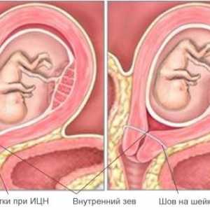 Incompetenta cervicala (CIN) în timpul sarcinii