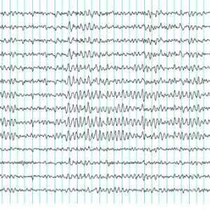 Electroencefalograf (EEG)