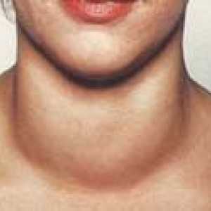 Deficitul de iod boli tiroidiene