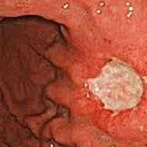 Tumorile carcinoide ale tractului gastro-intestinal
