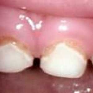 Tratamentul de dinți primari