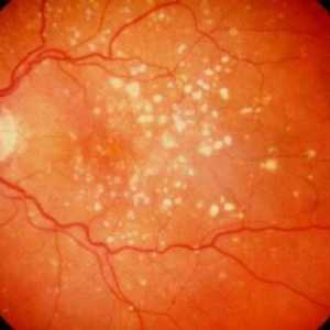 Carotenoidele în tratamentul legate de varsta degenerescenta maculara a retinei