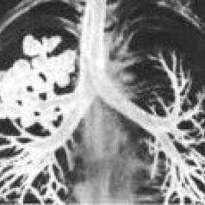 Hipoplazie chistice pulmonare