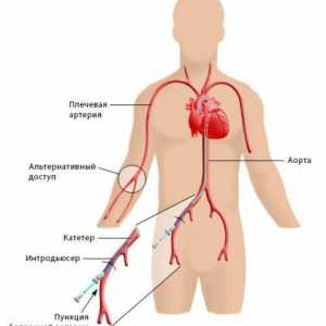 Angiografia coronariană (coronariană)