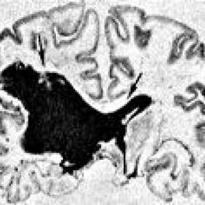 Sangerarea in ventriculii creierului