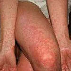 Febra dengue